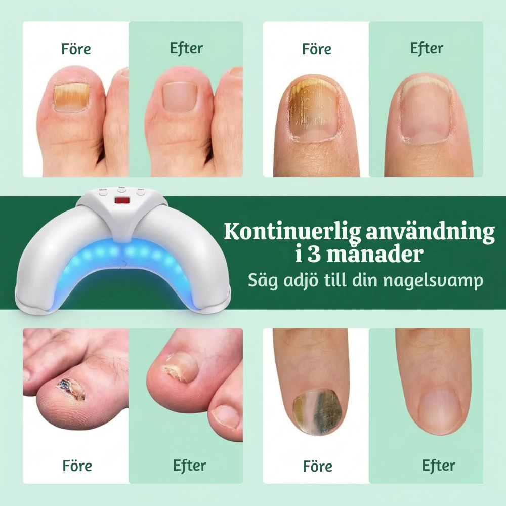 NailRevive™ – Avancerad 3-i-1 Nagelbehandlings Ljusenhet
