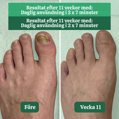 NailRevive™ – Avancerad 3-i-1 Nagelbehandlings Ljusenhet